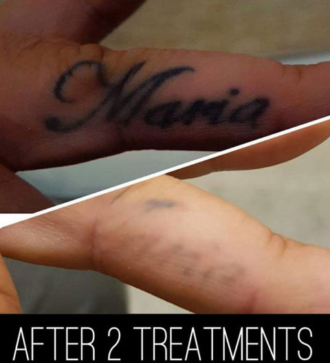 Laserpro Tattoo Removal - Adwords Guide 2