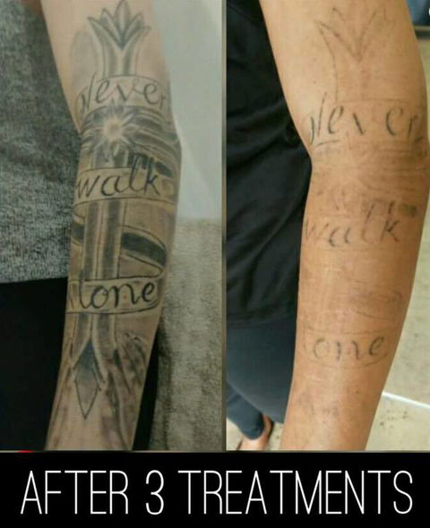 Laserpro Tattoo Removal - Adwords Guide 3