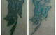 Laserpro Tattoo Removal - thumb 4