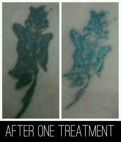 Laserpro Tattoo Removal - Adwords Guide 4